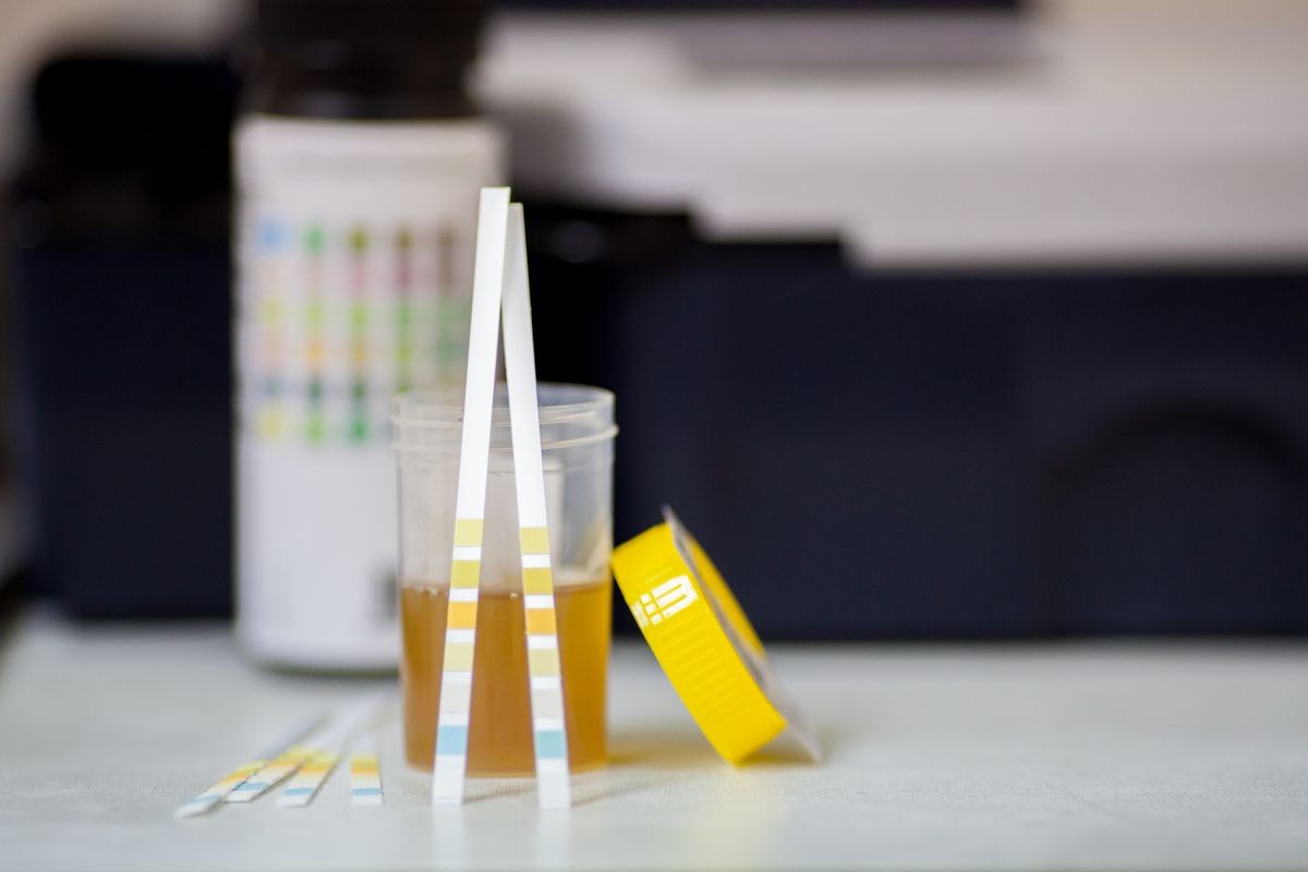 Urine strip and urine cup over urine strip reader in background. concept for laboratory testing 